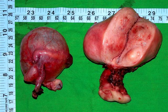 Uterus with right adnexal cyst of 7cm